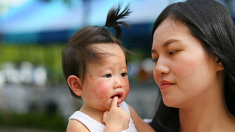 mom and baby, baby has rash on face